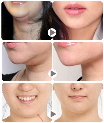 开颌是怎么形成的？揭秘口腔未闭合之门的成因与预防  第2张