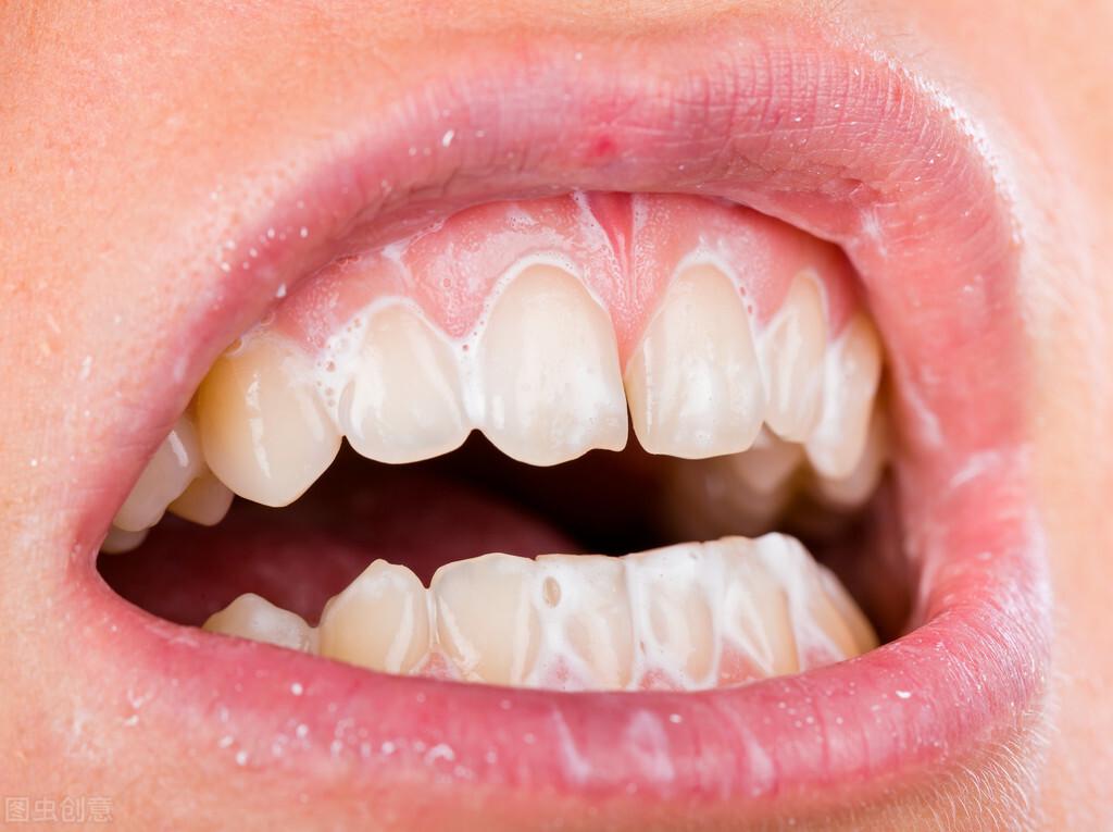 开颌是啥？揭秘口腔咬合异常的成因、症状与有效治疗方法  第1张