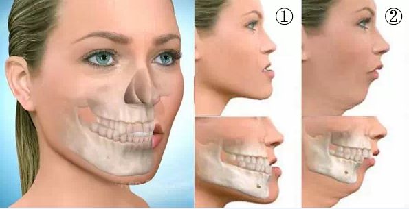开颌怎么治？从儿童到成人，5大矫正方法帮你轻松解决咬合烦恼