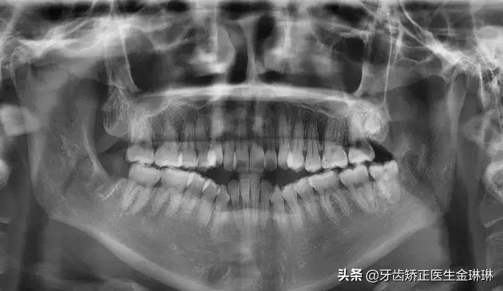开颌怎么治？从儿童到成人，5大矫正方法帮你轻松解决咬合烦恼